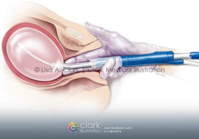 balloontamponade - Clark Medical Illustration Balloon Tamponade Device Medical Illustration