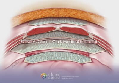 Abdominal Graft Illustration