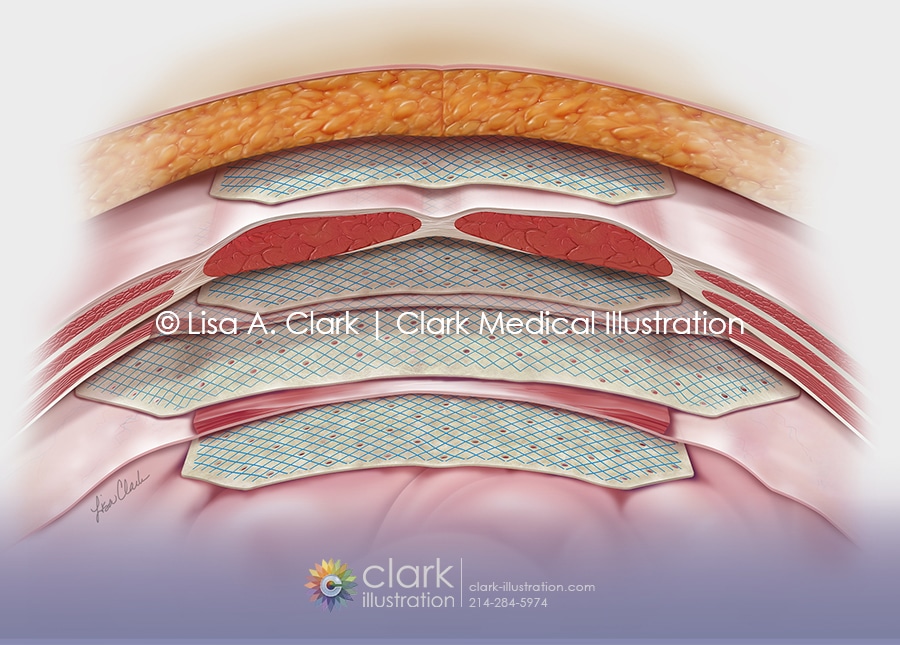 Abdominal Graft Illustration