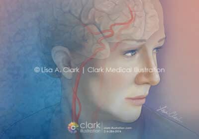 Carotid and Cerebral Artery Illustration - Clark Medical Illustration Carotid and Cerebral Artery Illustration