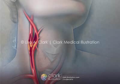 Carotid Stenosis Illustration