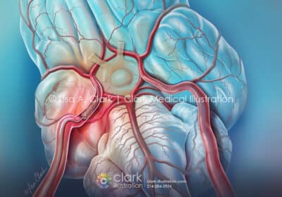 Endovascular Thrombectomy Illustration - Clark Medical Illustration Endovascular Thrombectomy Illustration