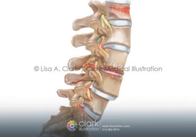 Spinal Conditions - Clark Medical Illustration Spinal Conditions Illustration