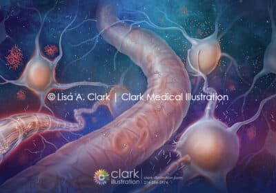 Alzheimer’s Markers in the Blood Illustration - Clark Medical Illustration Alzheimer’s Markers in the Blood Illustration