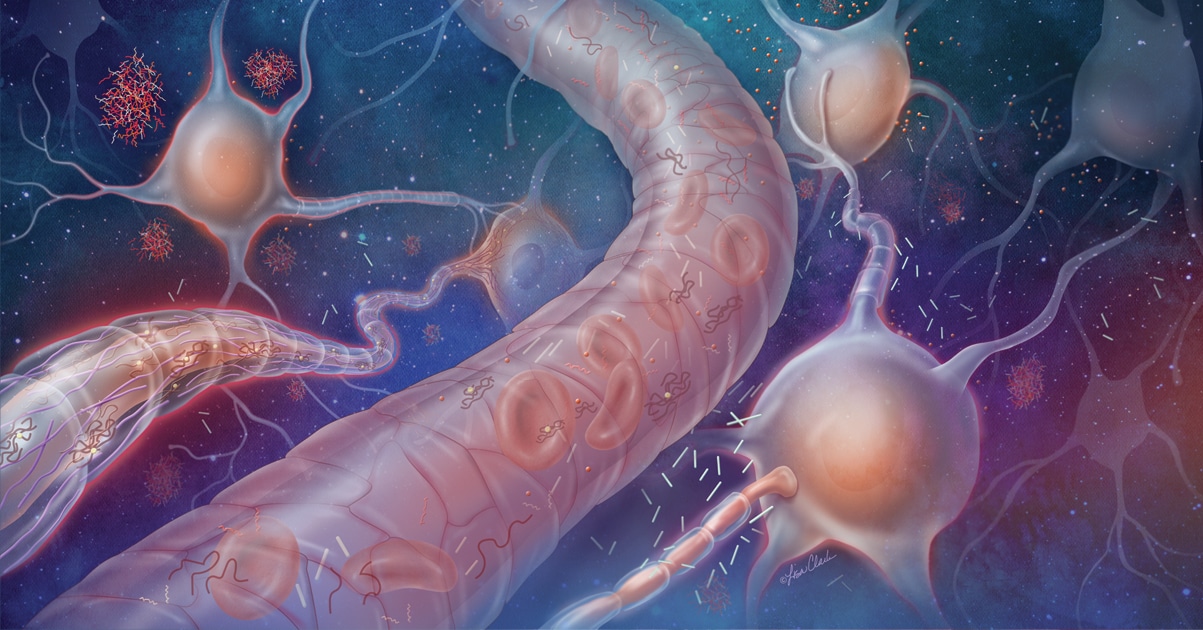 Alzheimers illustration