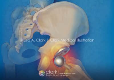 Hip Replacement Dislocation Illustration - Clark Medical Illustration Hip Replacement Dislocation Illustration