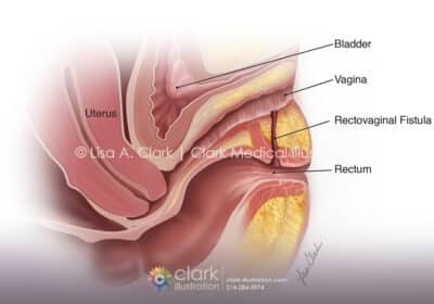 Rectovaginal Fistula Illustration - Clark Medical Illustration Rectovaginal Fistula Illustration