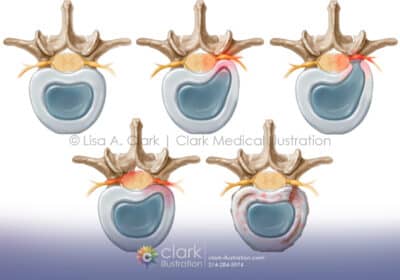 Vertebral Disc Disease illustration