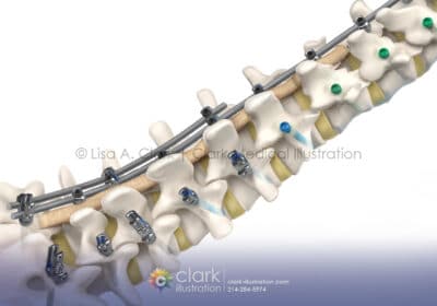 ModuleX Spinal System - Clark Medical Illustration Spinal Implant Medical Illustration