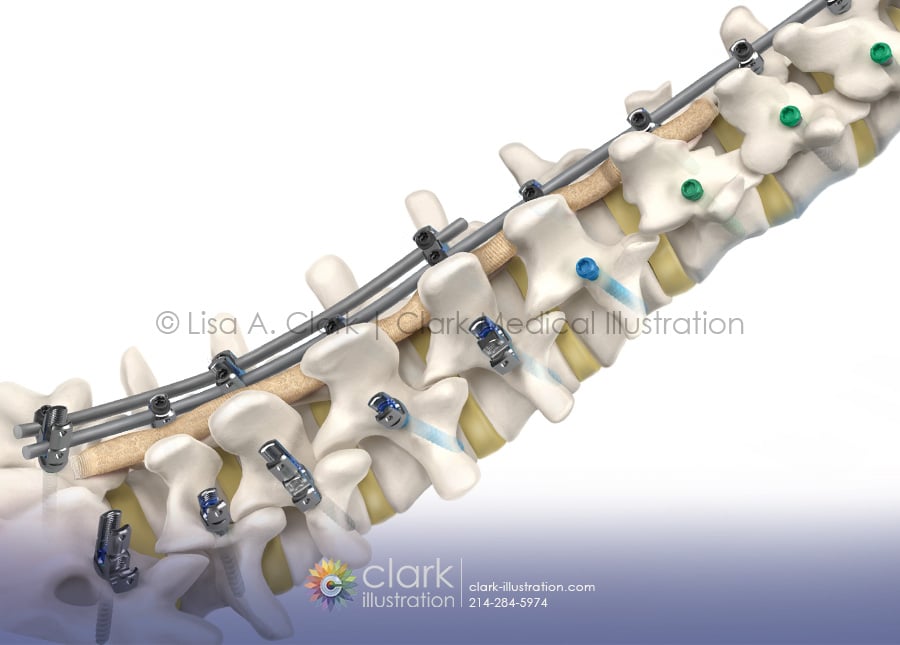 Spinal Implant Medical Illustration